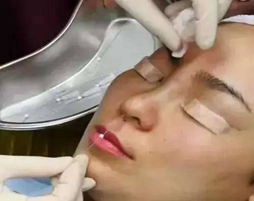 玻尿酸隆鼻VS线雕隆鼻