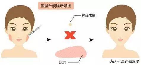 关于瘦脸针,你们想了解的都在这儿了