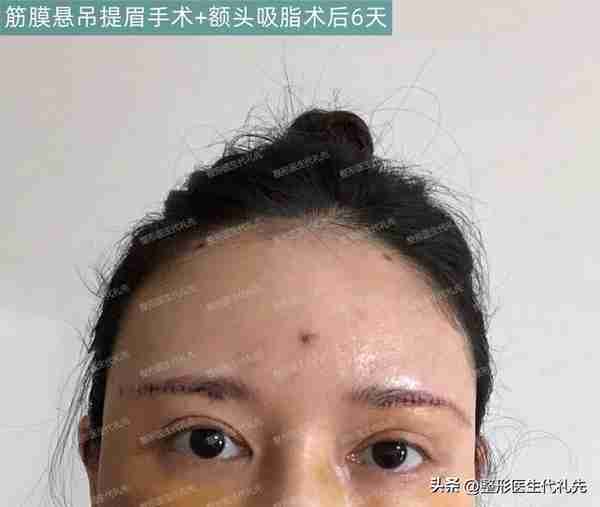 本身眼睛就长得非常好看,只想做个提眉手术恢复原来的双眼皮样子