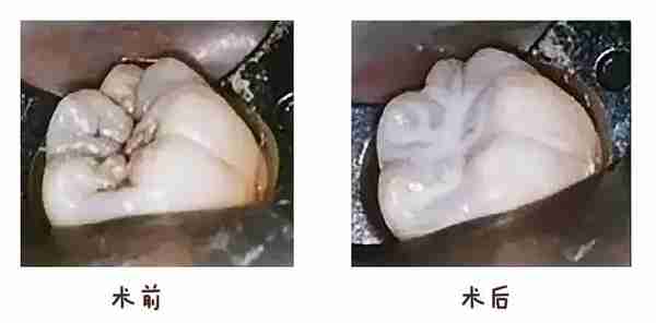 10个五岁小孩里面，就有7个有蛀牙