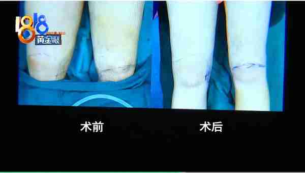 女子130多斤,花3万多抽脂后还是130多斤!医院:效果和个人体质有关,愿意提供二次调整