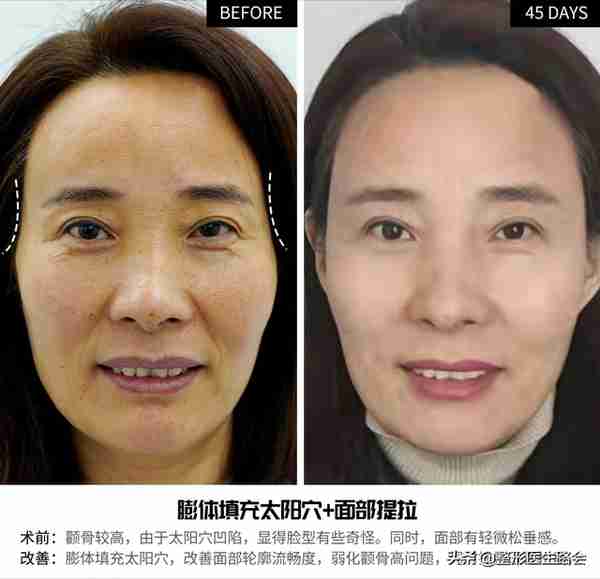 关于玻尿酸隆鼻、填充太阳穴、泪沟,那些医生不会告诉你的