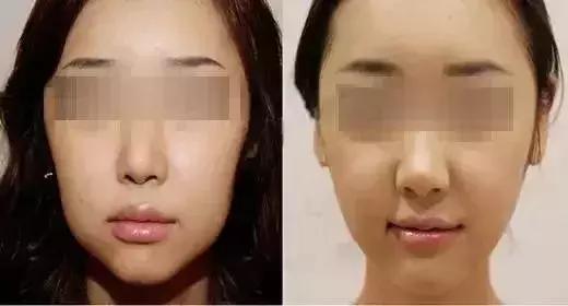 你适合打瘦脸针吗?