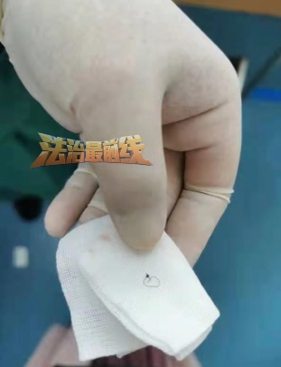 广西一美女割双眼皮,美容店老板切出“增生”还留疤