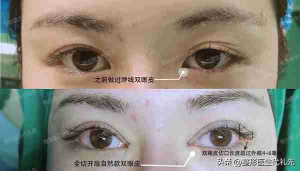 双眼皮被切得太长了太显老,这是什么原因?要怎么设计切口长度?