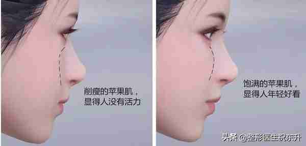 填充苹果肌,选“玻尿酸”好还是“自体脂肪”好?