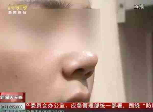 「天天看•热线」术后特别疼!19岁学生花7千多隆鼻,医生竟然说后果很严重