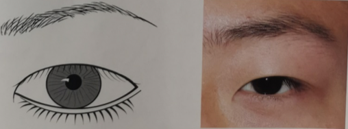 想割双眼皮,到底要不要开眼角?