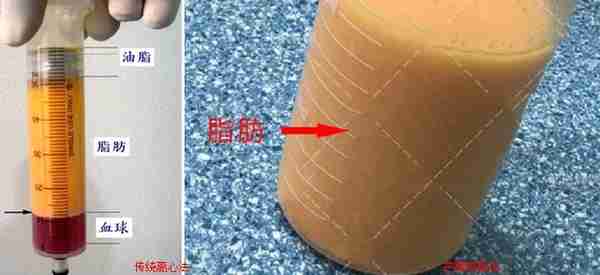 深度了解吸脂手术原来还有这么多后遗症知识盲点?