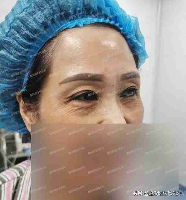 55岁忍受不了眼周皱纹凹陷,来北京做眼窝凹陷填充,全程真实记录