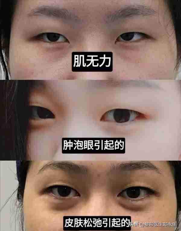 同样是割双眼皮,为什么有的人年轻了10岁,而有的人老了10岁?