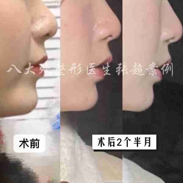 八大处张超面部吸脂反馈合集(五)