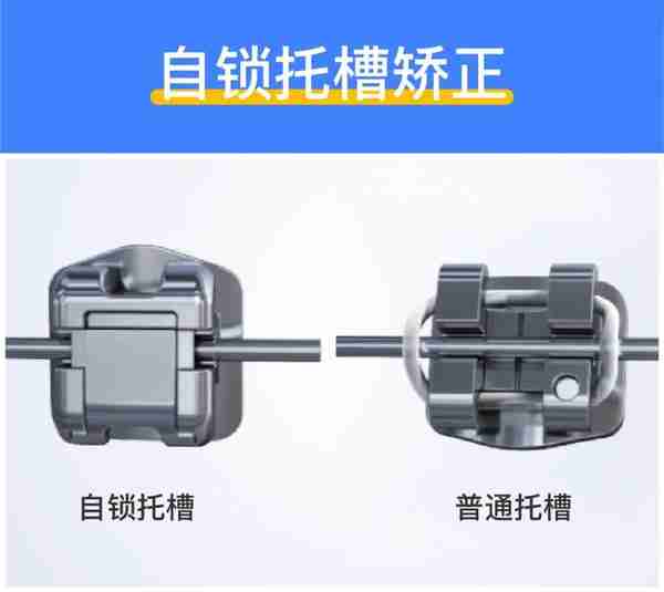 深度揭秘:牙齿矫正到底需要多少钱?