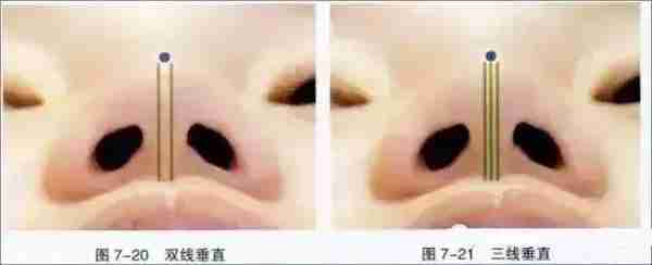 注射隆鼻、线雕隆鼻、假体隆鼻、自体肋骨隆鼻,哪个适合你?
