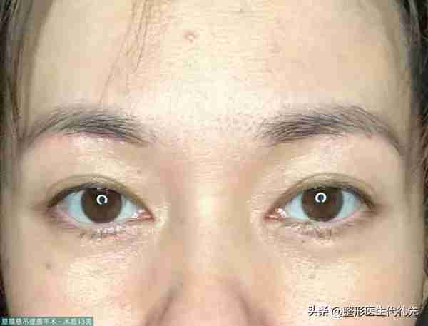 49岁眼皮松弛做提眉还是全切双眼皮?女士选择提眉手术,术后13天