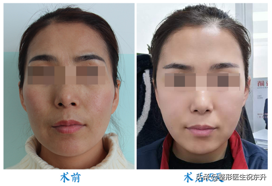 做了自体脂肪填充面部后,我来讲一讲这段经历