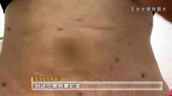 68万做“抽脂术”女子浑身长满黑色疤痕 后悔也来不及了