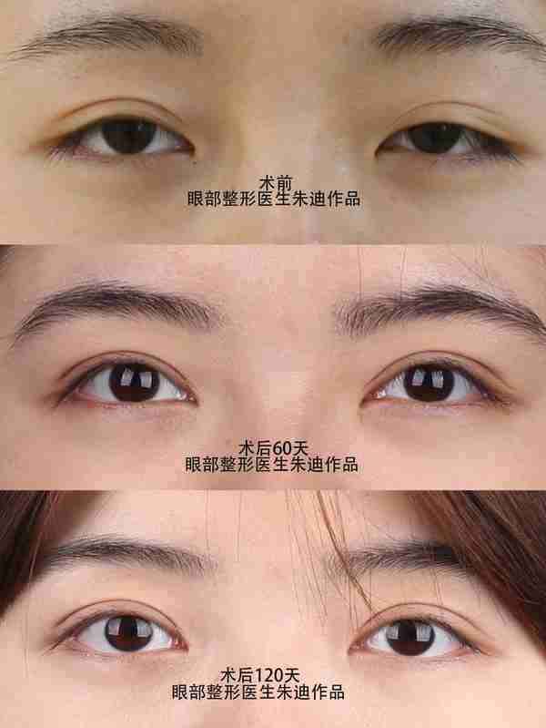 做双眼皮要花多少钱?怎么判断要不要开眼角?有哪些注意事项?