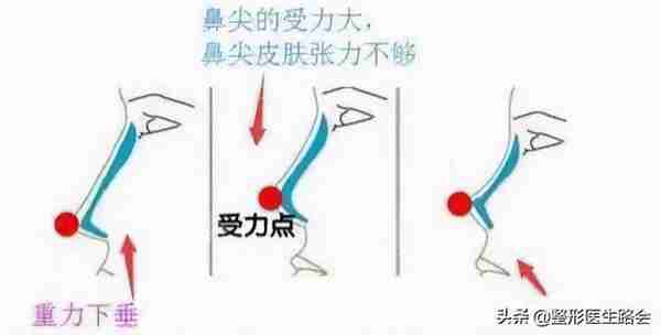 硅胶隆鼻是永久的吗?用它做鼻子有什么危害吗?
