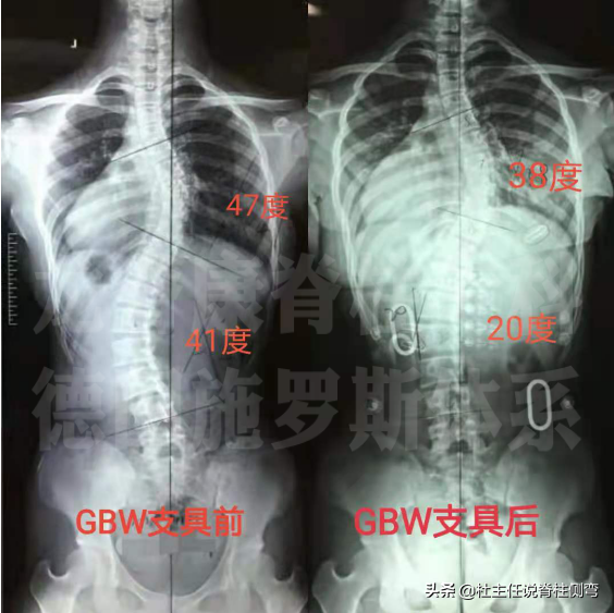 青少年特发性脊柱侧弯,可以做训练来减少侧弯度数的发展吗?