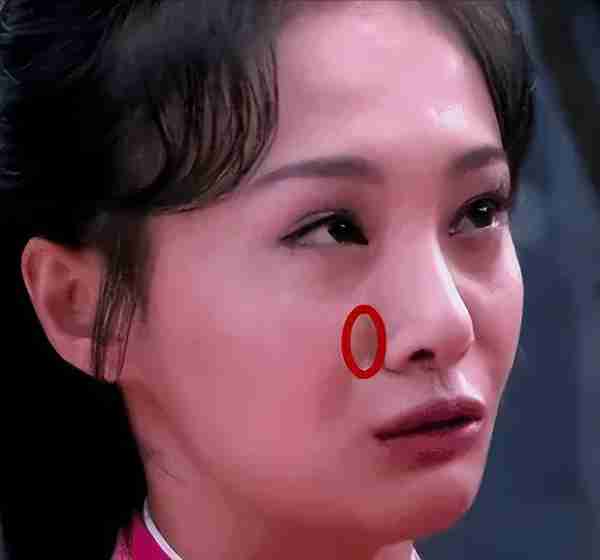 鼻基底凹陷显老态?打了玻尿酸,鼻基底变饱满,立马年轻十岁