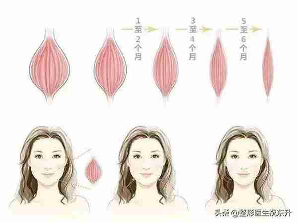 我打瘦脸针“差不多有10年”了,分享真实经验