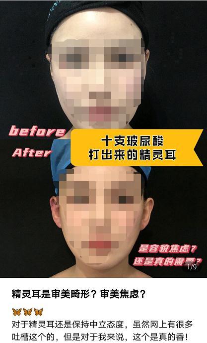网红“精灵耳”风靡 专家：正常耳朵往畸形了整