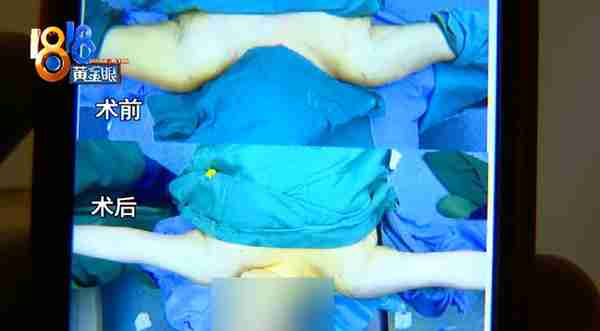 女子130多斤,花3万多抽脂后还是130多斤!医院:效果和个人体质有关,愿意提供二次调整