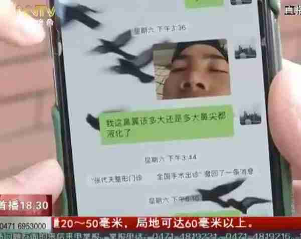 「天天看•热线」术后特别疼!19岁学生花7千多隆鼻,医生竟然说后果很严重