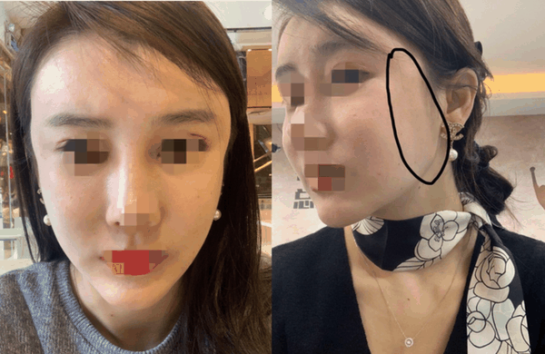 割双眼皮影响有多大?他们都是血淋淋的例子