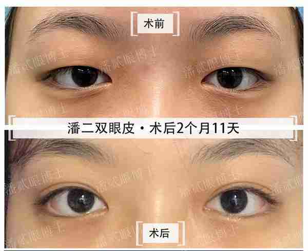 凸眼睛者:眼球突出、上睑凹陷或多层,双眼皮设计为何不宜过宽?