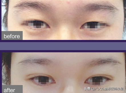 拥有迷人的双眼皮是美女们的标配,埋线双眼皮你一定要了解一下