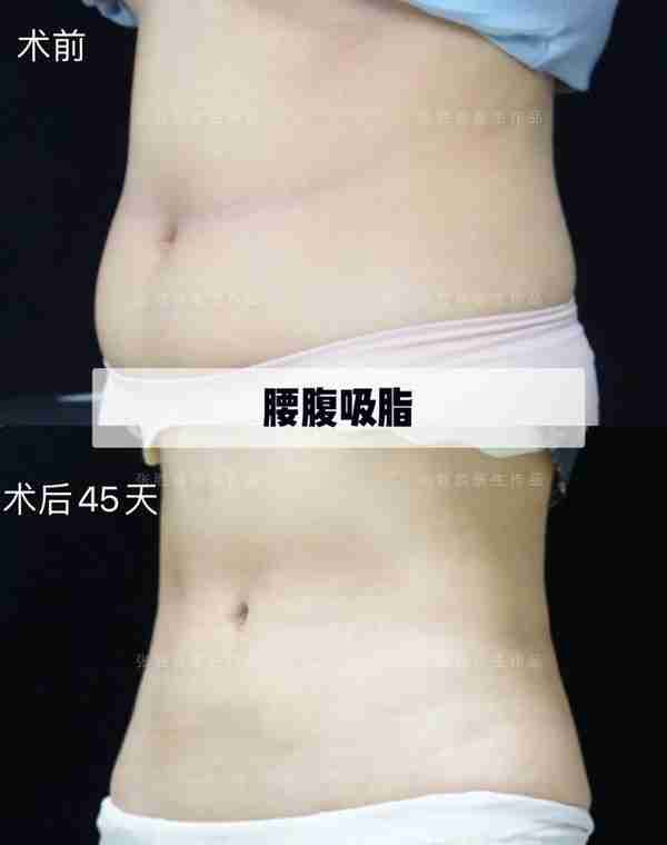 腰腹吸脂术后45天反馈