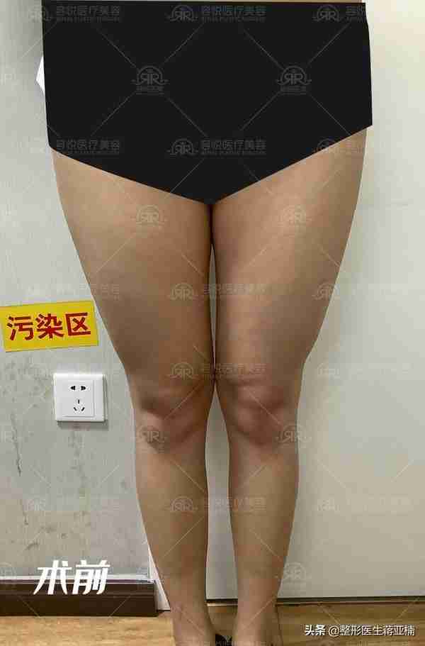 瘦人四肢吸脂,打造女性体形魅力