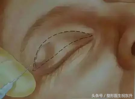 想做全切双眼皮,又担心不安全,有没有人可以给点真实性的建议?