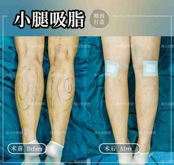 小腿吸脂 | 小腿粗成这样,还有得救吗?