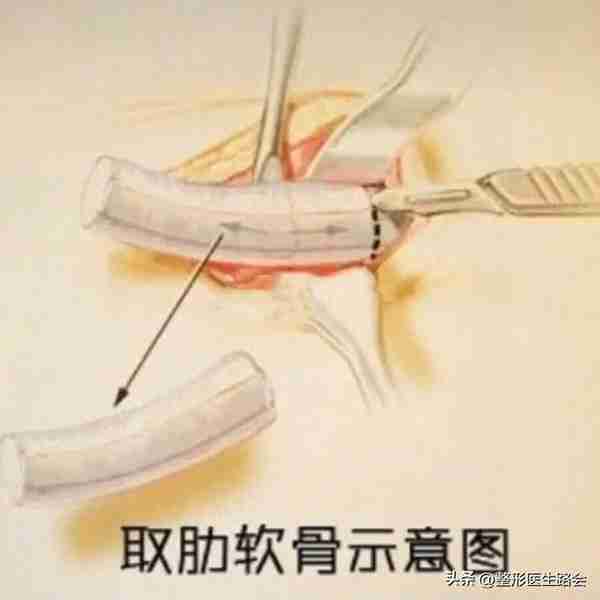 超体?超肋?舒铂?人工骨?曼特波?异体骨?肋骨?该如何选择?