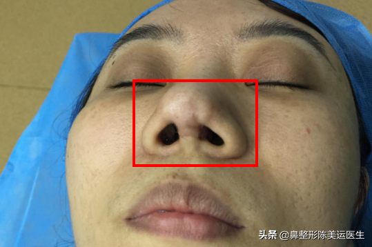 鼻整形术后严重疤痕增生该如何修复?