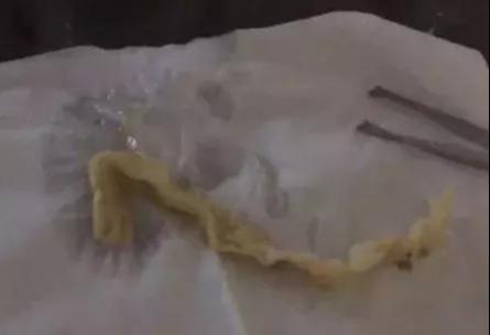 安徽女子花2万多隆鼻,总能闻到臭味!竟从鼻腔里取出一长条纱布