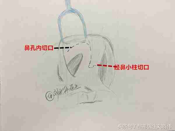 鼻整形科普：什么才是鼻综合手术？包含什么项目？
