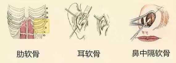 美丽焦点，俏翘鼻梁。那么多隆鼻材料，总有一款适合你
