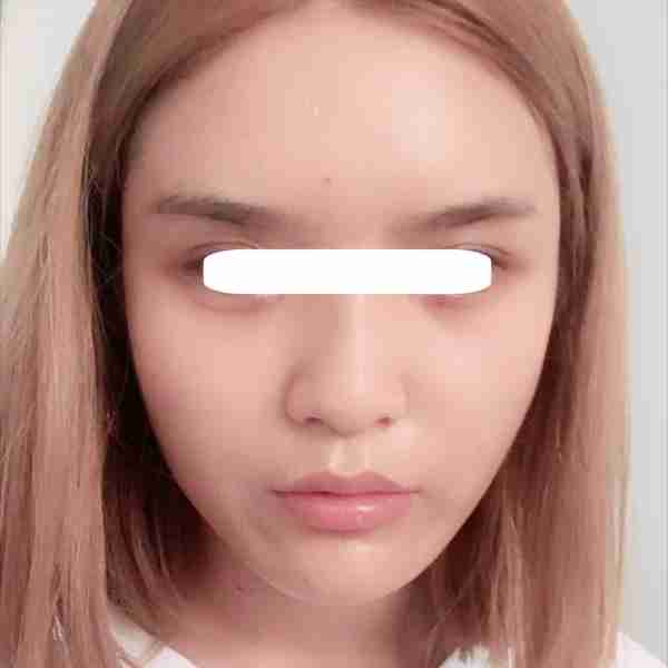 明星为什么喜欢“玻尿酸”填充全脸,而不是用自体脂肪填充呢?