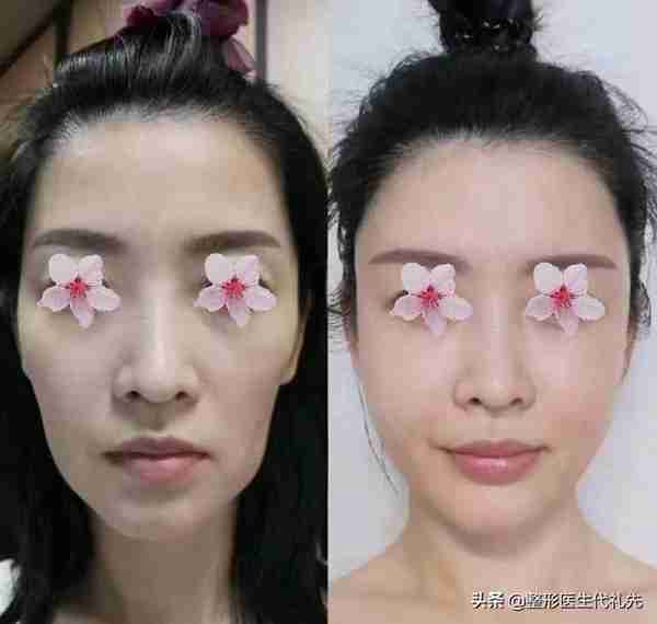 做脂肪填充之后,会下垂得更厉害?更容易显老?准备做面填来看看