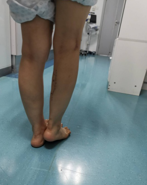 求美需谨慎!深圳一少女打瘦腿针致小腿肌肉挛缩 变长短腿