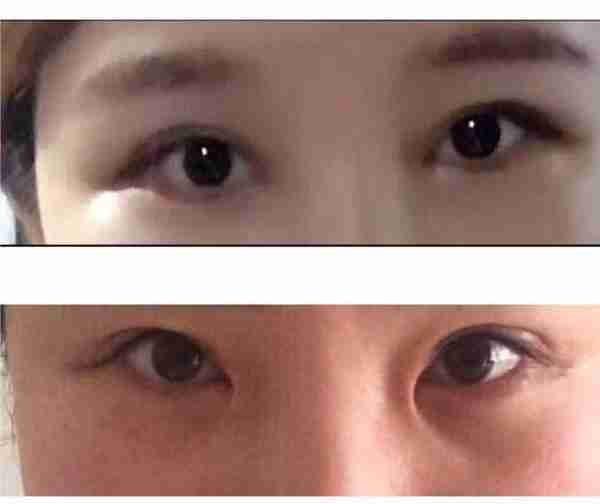 毁容、离婚、焦虑:生活崩坏在一场失败的眼整形后