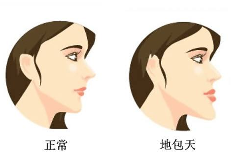 牙齿矫正能让脸型变好看吗?这三种情况一定有用,抓紧矫正
