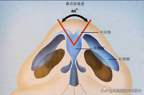 鼻整形术后严重疤痕增生该如何修复?