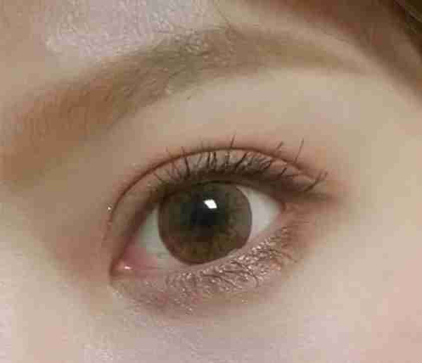 割双眼皮影响有多大?他们都是血淋淋的例子