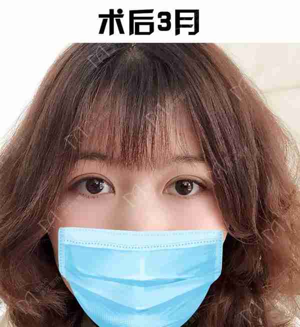 河南姑娘内双肿眼泡明显,我是如何给她设计自然款双眼皮的