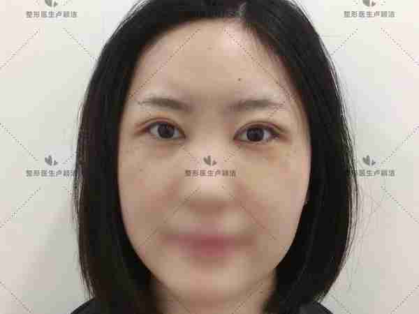 26岁白领割双眼皮,30天后恢复自然,老板直呼像换了个人